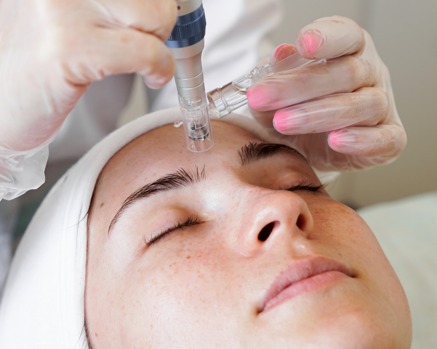 Micro Needling - Facial Treatment
