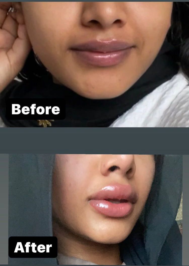 Lips - Semi Permanent Makeup