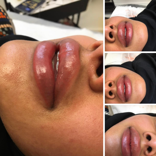 Full lip