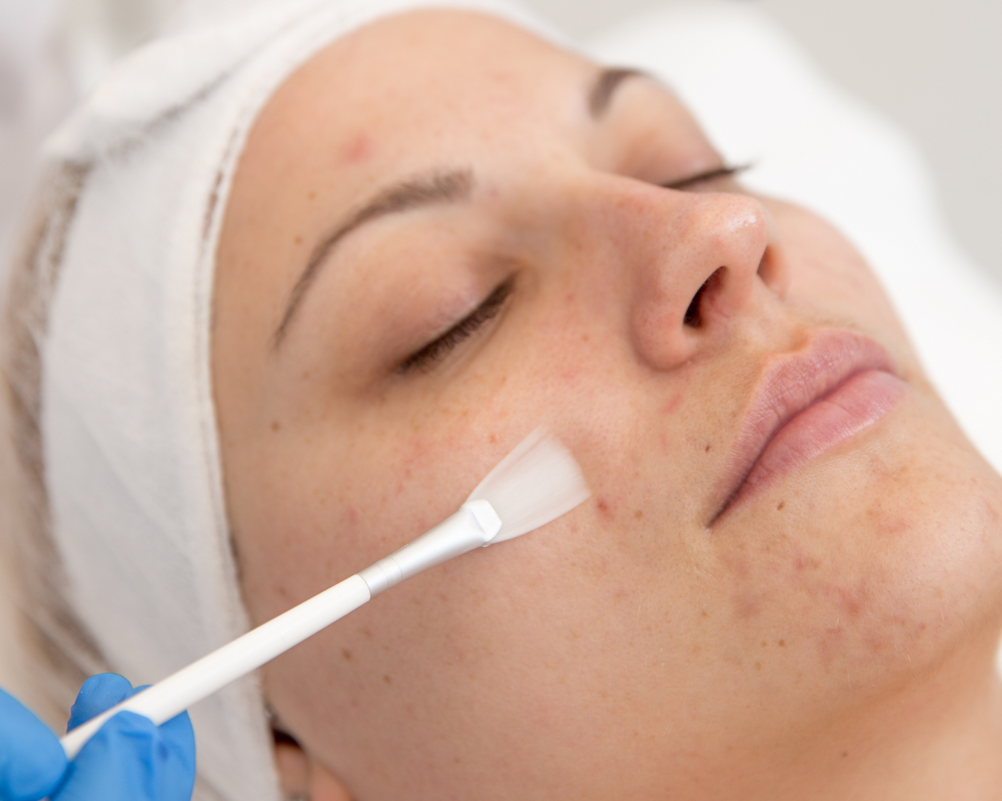 Skin Peel - Facial Treatment